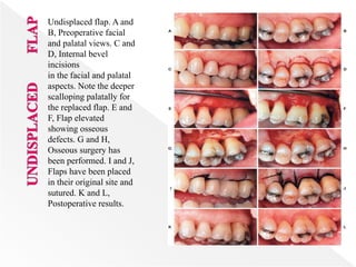 Undisplaced flap. A and
B, Preoperative facial
and palatal views. C and
D, Internal bevel
incisions
in the facial and palatal
aspects. Note the deeper
scalloping palatally for
the replaced flap. E and
F, Flap elevated
showing osseous
defects. G and H,
Osseous surgery has
been performed. I and J,
Flaps have been placed
in their original site and
sutured. K and L,
Postoperative results.
 