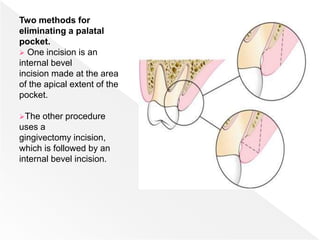 Two methods for
eliminating a palatal
pocket.
 One incision is an
internal bevel
incision made at the area
of the apical extent of the
pocket.
The other procedure
uses a
gingivectomy incision,
which is followed by an
internal bevel incision.
 