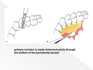 primary incision is made intracrevicularly through
the bottom of the periodontal pocket
 