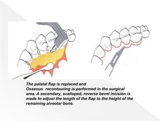 The palatal flap is replaced and
Osseous recontouring is performed in the surgical
area. A secondary, scalloped, reverse bevel incision is
made to adjust the length of the flap to the height of the
remaining alveolar bone.
 