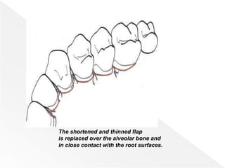 The shortened and thinned flap
is replaced over the alveolar bone and
in close contact with the root surfaces.
 