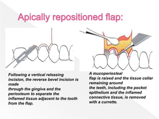 Following a vertical releasing
incision, the reverse bevel incision is
made
through the gingiva and the
periosteum to separate the
inflamed tissue adjacent to the tooth
from the flap.
A mucoperiosteal
flap is raised and the tissue collar
remaining around
the teeth, including the pocket
epithelium and the inflamed
connective tissue, is removed
with a currette.
 
