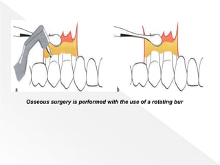 Osseous surgery is performed with the use of a rotating bur
 
