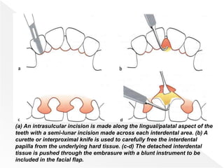 (a) An intrasulcular incision is made along the lingual/palatal aspect of the
teeth with a semi-lunar incision made across each interdental area. (b) A
curette or interproximal knife is used to carefully free the interdental
papilla from the underlying hard tissue. (c-d) The detached interdental
tissue is pushed through the embrasure with a blunt instrument to be
included in the facial flap.
 