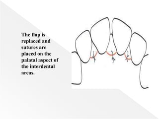 The flap is
replaced and
sutures are
placed on the
palatal aspect of
the interdental
areas.
 