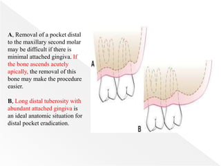A, Removal of a pocket distal
to the maxillary second molar
may be difficult if there is
minimal attached gingiva. If
the bone ascends acutely
apically, the removal of this
bone may make the procedure
easier.
B, Long distal tuberosity with
abundant attached gingiva is
an ideal anatomic situation for
distal pocket eradication.
 