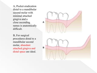 A, Pocket eradication
distal to a mandibular
second molar with
minimal attached
gingiva and a
close ascending
ramus is anatomically
difficult.
B, For surgical
procedures distal to a
mandibular second
molar, abundant
attached gingiva and
distal space are ideal.
 
