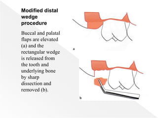 Modified distal
wedge
procedure
Buccal and palatal
flaps are elevated
(a) and the
rectangular wedge
is released from
the tooth and
underlying bone
by sharp
dissection and
removed (b).
 