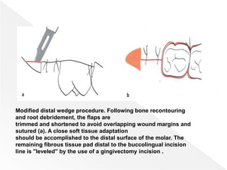 Modified distal wedge procedure. Following bone recontouring
and root debridement, the flaps are
trimmed and shortened to avoid overlapping wound margins and
sutured (a). A close soft tissue adaptation
should be accomplished to the distal surface of the molar. The
remaining fibrous tissue pad distal to the buccolingual incision
line is "leveled" by the use of a gingivectomy incision .
 