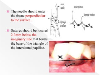  The needle should enter
the tissue perpendicular
to the surface .
 Sutures should be located
2-3mm below the
imaginary line that forms
the base of the triangle of
the interdental papillae.
 