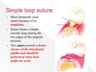  Most commonly used
suture because of its
simplicity.
 Suture forms a simple
circular loop uniting the
two edges of the surgical
incision.
 This suture permits a better
closure of the interdental
papilla and should be
performed when bone
grafts are used.
 