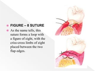  FIGURE – 8 SUTURE
 As the name tells, this
suture forms a loop with
a figure of eight, with the
criss‐cross limbs of eight
placed between the two
flap edges.
 