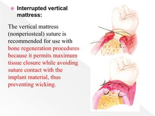  Interrupted vertical
mattress:
The vertical mattress
(nonperiosteal) suture is
recommended for use with
bone regeneration procedures
because it permits maximum
tissue closure while avoiding
suture contact with the
implant material, thus
preventing wicking.
 