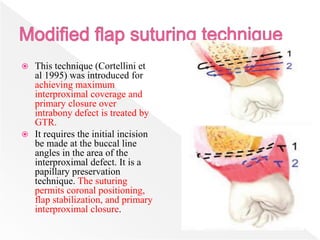 This technique (Cortellini et
al 1995) was introduced for
achieving maximum
interproximal coverage and
primary closure over
intrabony defect is treated by
GTR.
 It requires the initial incision
be made at the buccal line
angles in the area of the
interproximal defect. It is a
papillary preservation
technique. The suturing
permits coronal positioning,
flap stabilization, and primary
interproximal closure.
 