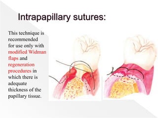 This technique is
recommended
for use only with
modified Widman
flaps and
regeneration
procedures in
which there is
adequate
thickness of the
papillary tissue.
 
