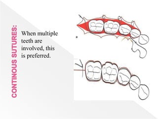 When multiple
teeth are
involved, this
is preferred.
 