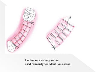 Continuous locking suture
used primarily for edentulous areas.
 