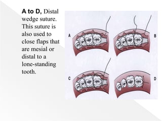 A to D, Distal
wedge suture.
This suture is
also used to
close flaps that
are mesial or
distal to a
lone-standing
tooth.
 