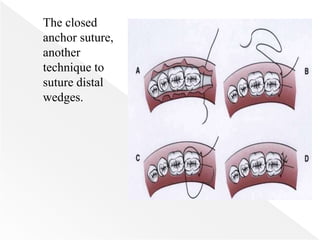 The closed
anchor suture,
another
technique to
suture distal
wedges.
 