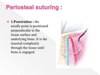  1.Penetration : the
needle point is positioned
perpendicular to the
tissue surface and
underlying bone. It is the
inserted completely
through the tissue until
bone is engaged.
 