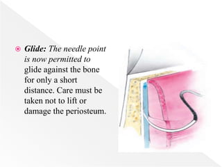  Glide: The needle point
is now permitted to
glide against the bone
for only a short
distance. Care must be
taken not to lift or
damage the periosteum.
 