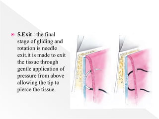  5.Exit : the final
stage of gliding and
rotation is needle
exit.it is made to exit
the tissue through
gentle application of
pressure from above
allowing the tip to
pierce the tissue.
 