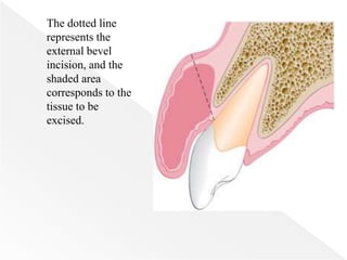 The dotted line
represents the
external bevel
incision, and the
shaded area
corresponds to the
tissue to be
excised.
 