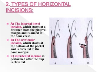  A) The internal bevel
incision, which starts at a
distance from the gingival
margin and is aimed at
the bone crest.
 B) The crevicular
incision, which starts at
the bottom of the pocket
and is directed to the
bone margin.
 C) interdental incision is
performed after the flap
is elevated.
 