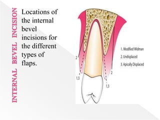 Locations of
the internal
bevel
incisions for
the different
types of
flaps.
 