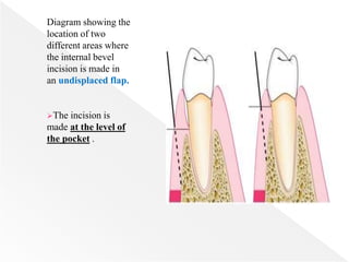 Diagram showing the
location of two
different areas where
the internal bevel
incision is made in
an undisplaced flap.
The incision is
made at the level of
the pocket .
 
