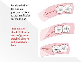 Incision designs
for surgical
procedures distal
to the mandibular
second molar.
The incision
should follow the
areas of greatest
attached gingiva
and underlying
bone.
 