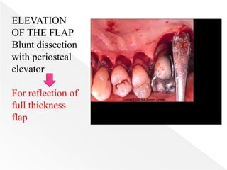 ELEVATION
OF THE FLAP
Blunt dissection
with periosteal
elevator
For reflection of
full thickness
flap
 