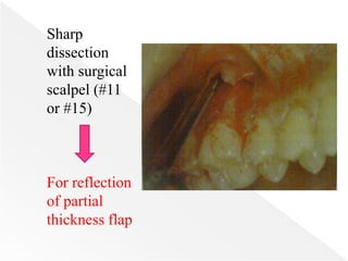Sharp
dissection
with surgical
scalpel (#11
or #15)
For reflection
of partial
thickness flap
 