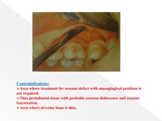 Contraindications:
Area where treatment for osseous defect with mucogingival problem is
not required.
Thin periodontal tissue with probable osseous dehiscence and osseous
fenestration.
Area where alveolar bone is thin.
 
