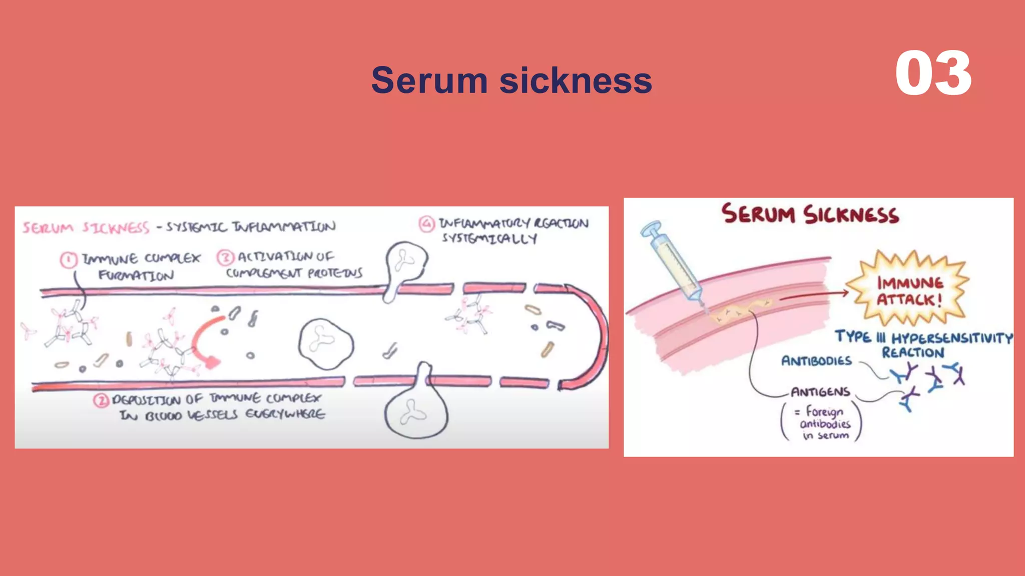 03Serum sickness
 