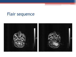 Cerebellar cyst a case on mri Slide 10