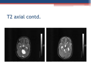Cerebellar cyst a case on mri Slide 6