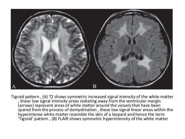 Diagnostic Imaging of Degenerative & White Matter Diseases