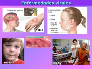 Enfermedades virales
rubéola
mononucleosis
rabia
sida
 