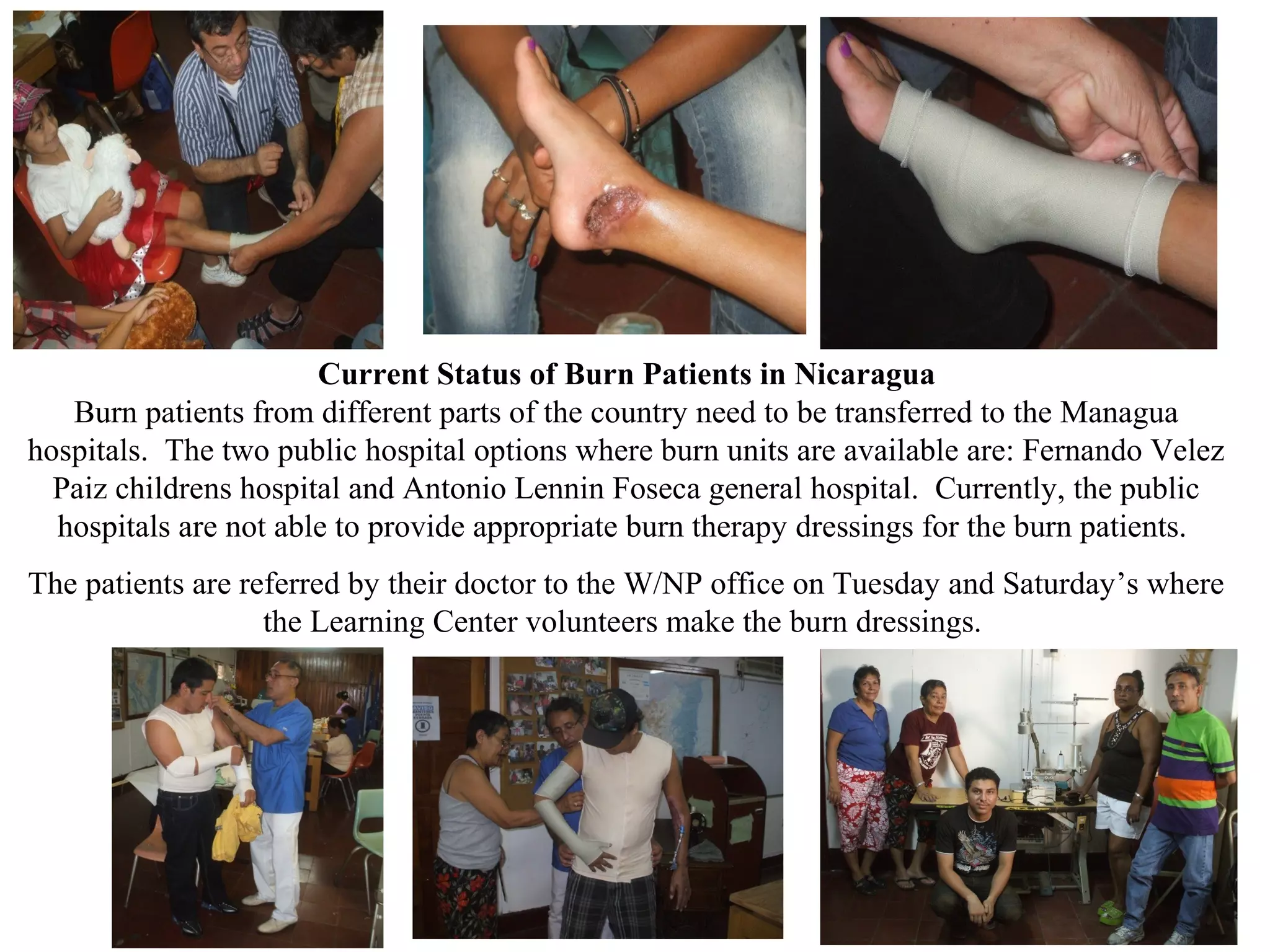 Current Status of Burn Patients in Nicaragua
Burn patients from different parts of the country need to be transferred to the Managua
hospitals. The two public hospital options where burn units are available are: Fernando Velez
Paiz childrens hospital and Antonio Lennin Foseca general hospital. Currently, the public
hospitals are not able to provide appropriate burn therapy dressings for the burn patients.
The patients are referred by their doctor to the W/NP office on Tuesday and Saturday’s where
the Learning Center volunteers make the burn dressings.

 