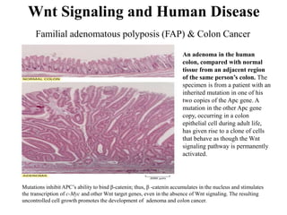 Mutations inhibit APC’s ability to bind β-catenin; thus, β -catenin accumulates in the nucleus and stimulates
the transcription of c-Myc and other Wnt target genes, even in the absence of Wnt signaling. The resulting
uncontrolled cell growth promotes the development of adenoma and colon cancer.
Wnt Signaling and Human Disease
Familial adenomatous polyposis (FAP) & Colon Cancer
An adenoma in the human
colon, compared with normal
tissue from an adjacent region
of the same person’s colon. The
specimen is from a patient with an
inherited mutation in one of his
two copies of the Apc gene. A
mutation in the other Apc gene
copy, occurring in a colon
epithelial cell during adult life,
has given rise to a clone of cells
that behave as though the Wnt
signaling pathway is permanently
activated.
 