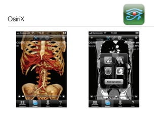 OsiriX
 