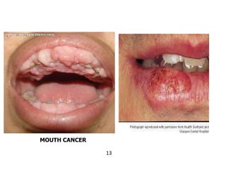 13
MOUTH CANCER
 