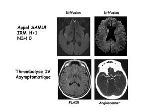 Diffusion
FLAIR Angioscanner
Appel SAMU!
IRM H+1
NIH 0
Diffusion
Thrombolyse IV
Asymptomatique
 