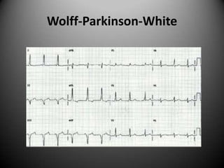 Wolff-Parkinson-White