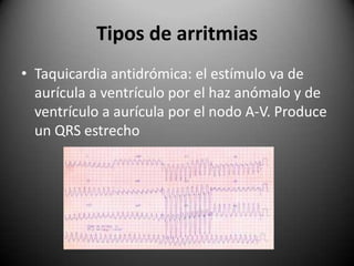 Tipos de arritmiasTaquicardia antidrómica: el estímulo va de aurícula a ventrículo por el haz anómalo y de ventrículo a aurícula por el nodo A-V. Produce un QRS estrecho