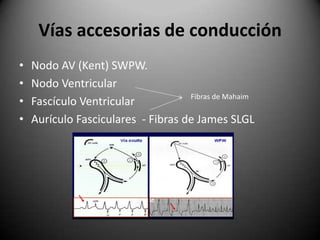 Vías accesorias de conducciónNodo AV (Kent) SWPW.Nodo VentricularFascículo VentricularAurículo Fasciculares  - Fibras de James SLGLFibras de Mahaim