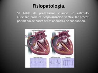 Fisiopatología.Se habla de preexitación cuando un estímulo auricular, produce despolarización ventricular precoz por medio de haces o vías anómalas de conducción.