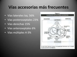 Vías accesorias más frecuentesVías laterales Izq. 56%Vías posteroseptales 23%Vías derechas 15%Vías anteroseptales 6%Vías múltiples 4-3%