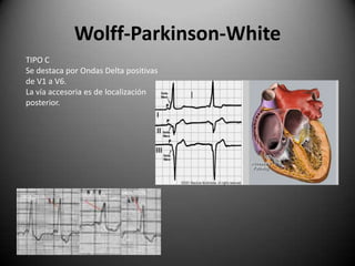 Wolff-Parkinson-WhiteTIPO C Se destaca por Ondas Delta positivasde V1 a V6.La vía accesoria es de localizaciónposterior.